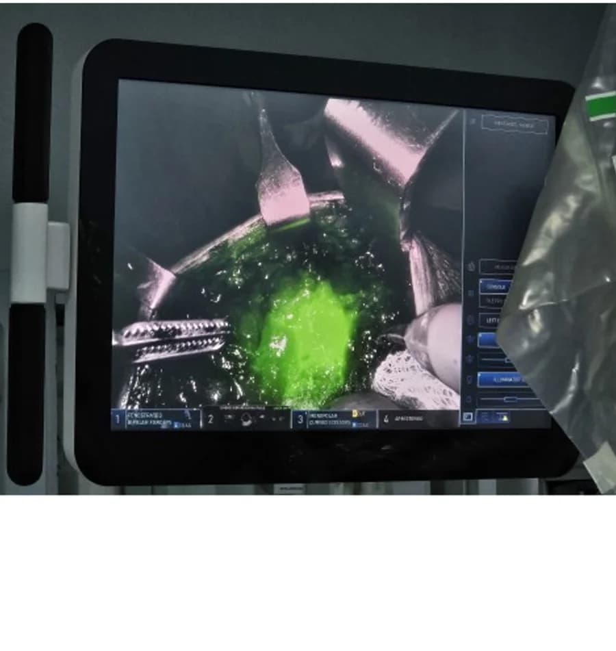 ICG-labelled breast lesion glowing green under the da Vinci Firefly near-infrared fluorescence camera